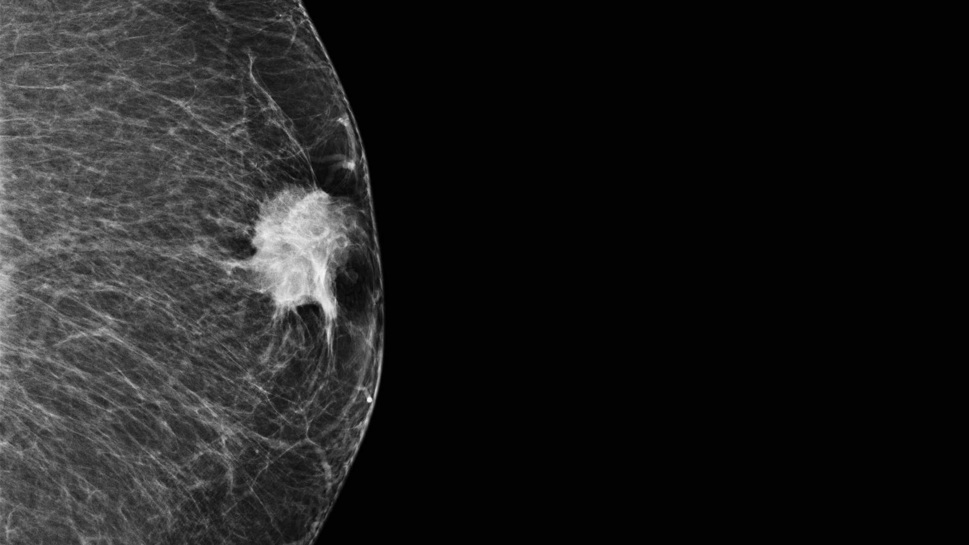 De tumor die niemand opmerkt | EOS Wetenschap