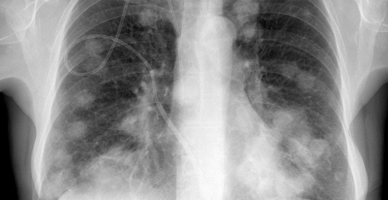Waarom zaait kanker vaak uit naar de longen? | EOS Wetenschap