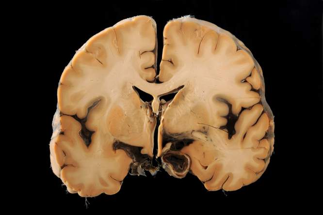 Hersenbloeding voorkomen met injecteerbare tandpasta-achtige biomaterialen