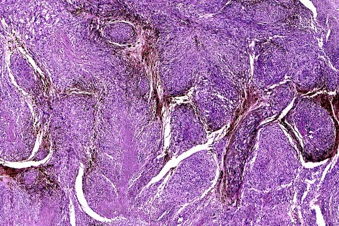 Immunotherapie biedt kans op genezing van uitgezaaid melanoom