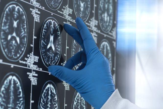 Kunnen sommige kankermedicijnen ook alzheimer verslaan?