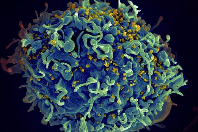 Nieuwe behandeling maakt aidsvirus wellicht definitief onschadelijk