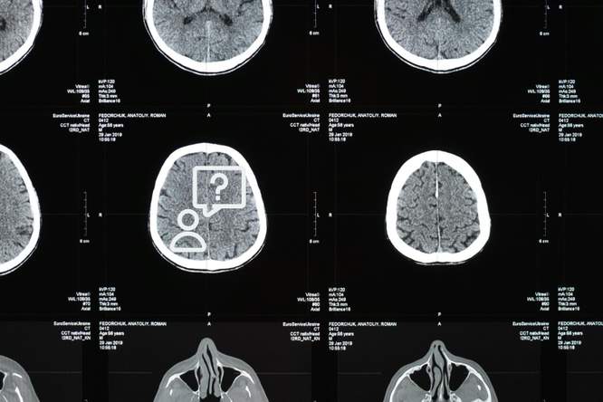 Waarom horen mensen met schizofrenie stemmen?