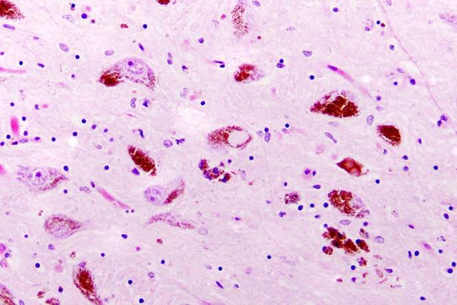 Parkinson valt op te sporen vóór eerste symptomen ontstaan