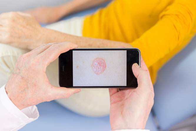 Psoriasis gaat gepaard met psychische stoornissen